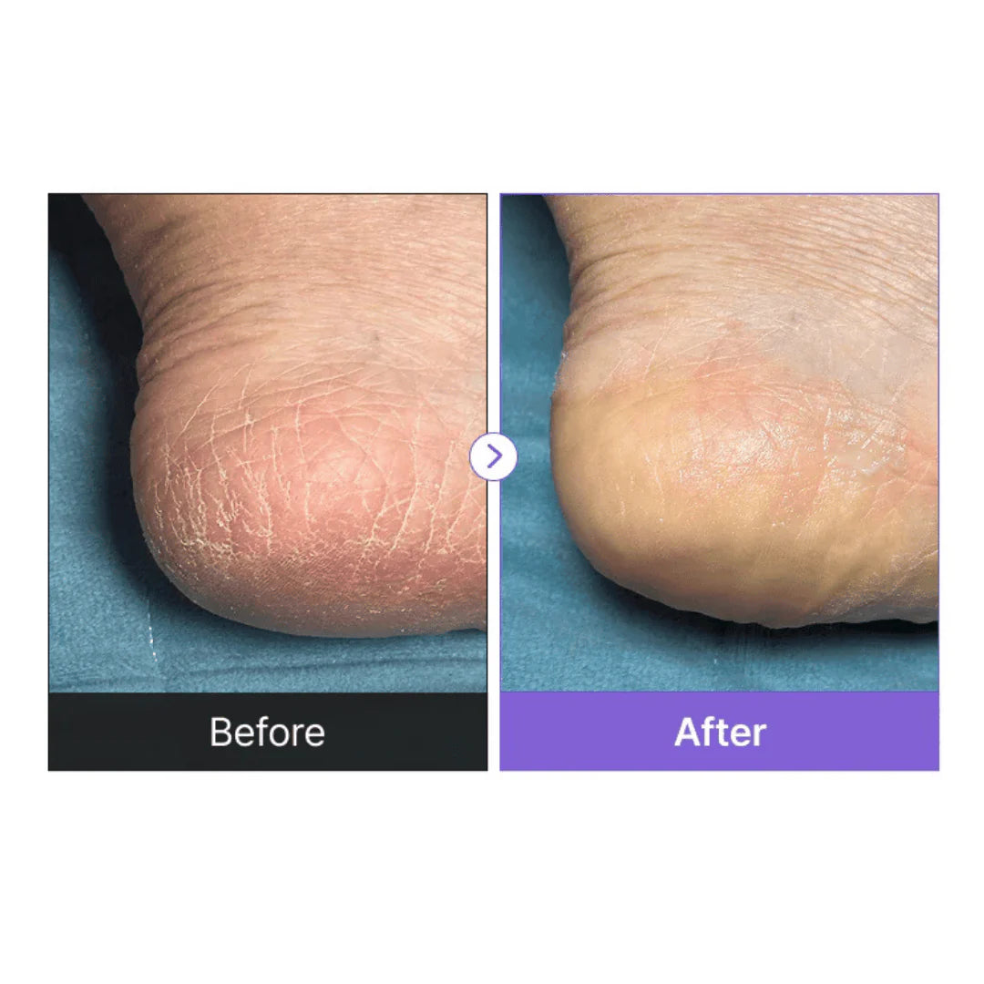 baren - Shea Butter Sleeping Heel Patch